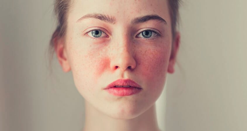 đắp mặt nạ tinh bột nghệ giúp giảm kích ứng da